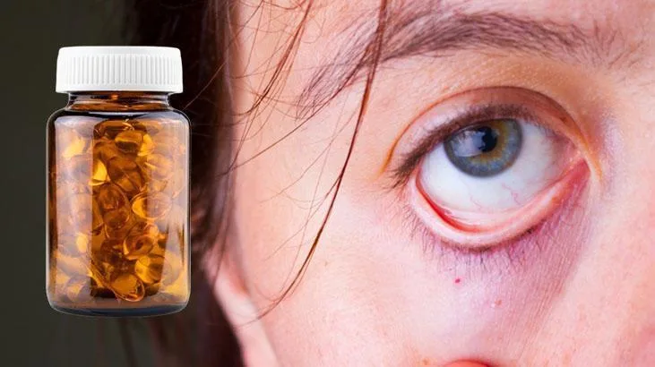 Göz altı morluğu hangi vitamin eksikliğinden kaynaklanır? Yorgunlukla birleşiyor