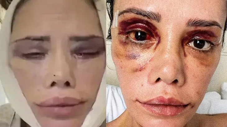 Yüz nakli olan Survivor Didem Ceran son halini paylaştı! 'Hepinizden çok özür diliyorum'